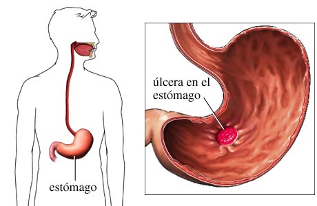 Archivo:Ulcera estomago 02.jpg